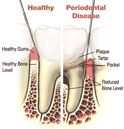 Colorado Springs dental implants