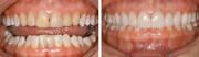 PORCELAIN VENEERS  - Dental Lounge SHEIKH ZAYED ROAD