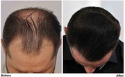 ForHair Hair Transplant Clinic Alpharetta