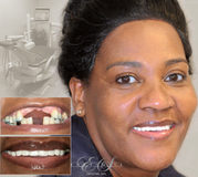 Dental implant in Brooklyn