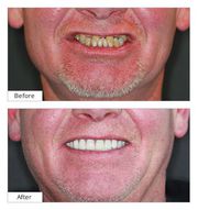 Dental Implants in Brooklyn