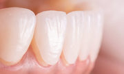 Dental Veneers in NYC