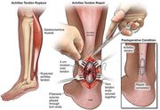 Achilles Tendon Repair Surgery in NYC