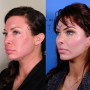 Rhinoplasty in NYC