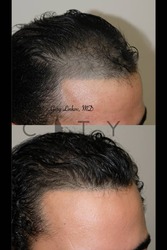 Hair Transplant NYC