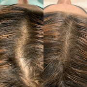 Micropigmentation Scalp NYC