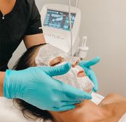 Best Treatment of Microneedling in Los Angeles