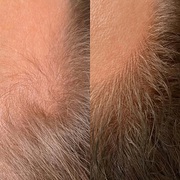 Micropigmentation Scalp NYC