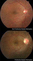 Diabetic Retinopathy Treatment in NYC