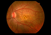 Macular Degeneration Treatment in NYC