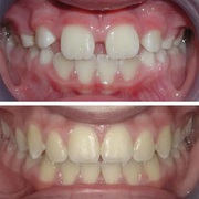 Invisalign NYC