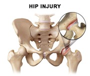 Hip Pain Treatment in Bronx