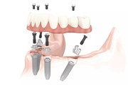 Average Cost Of Dental Implants