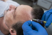 Understanding Hair Transplant with Dr. Amit Gupta: Your Trusted Cosmet